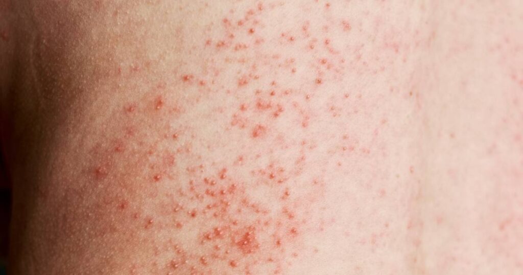 mold health problems